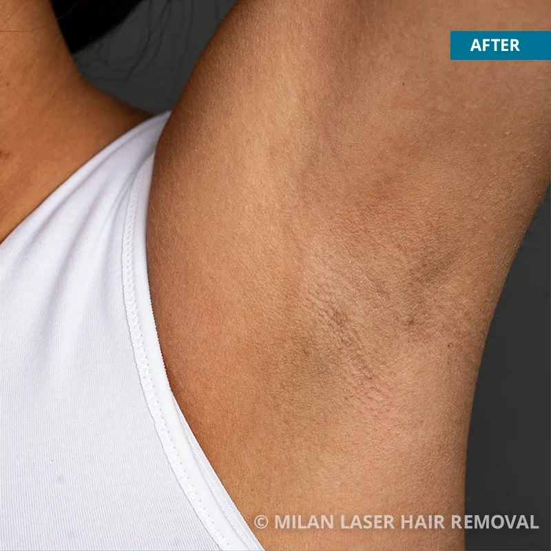 Underarm Before & After Photos of Laser Hair Removal | Milan Laser in Twin  Falls, ID